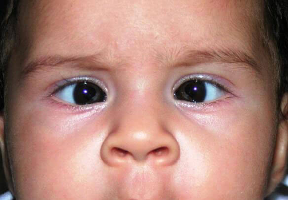 Cross-Eyed Baby (Strabismus): Causes and Treatment